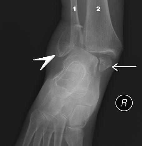 Figure 22. Bimalleolar ankle fracture with dislocation: fractures of both the fibula (1) and the tibial (medial) malleolus (2). Steven Fruitsmaak, CC BY-SA 3.0, via Wikimedia Commons.
