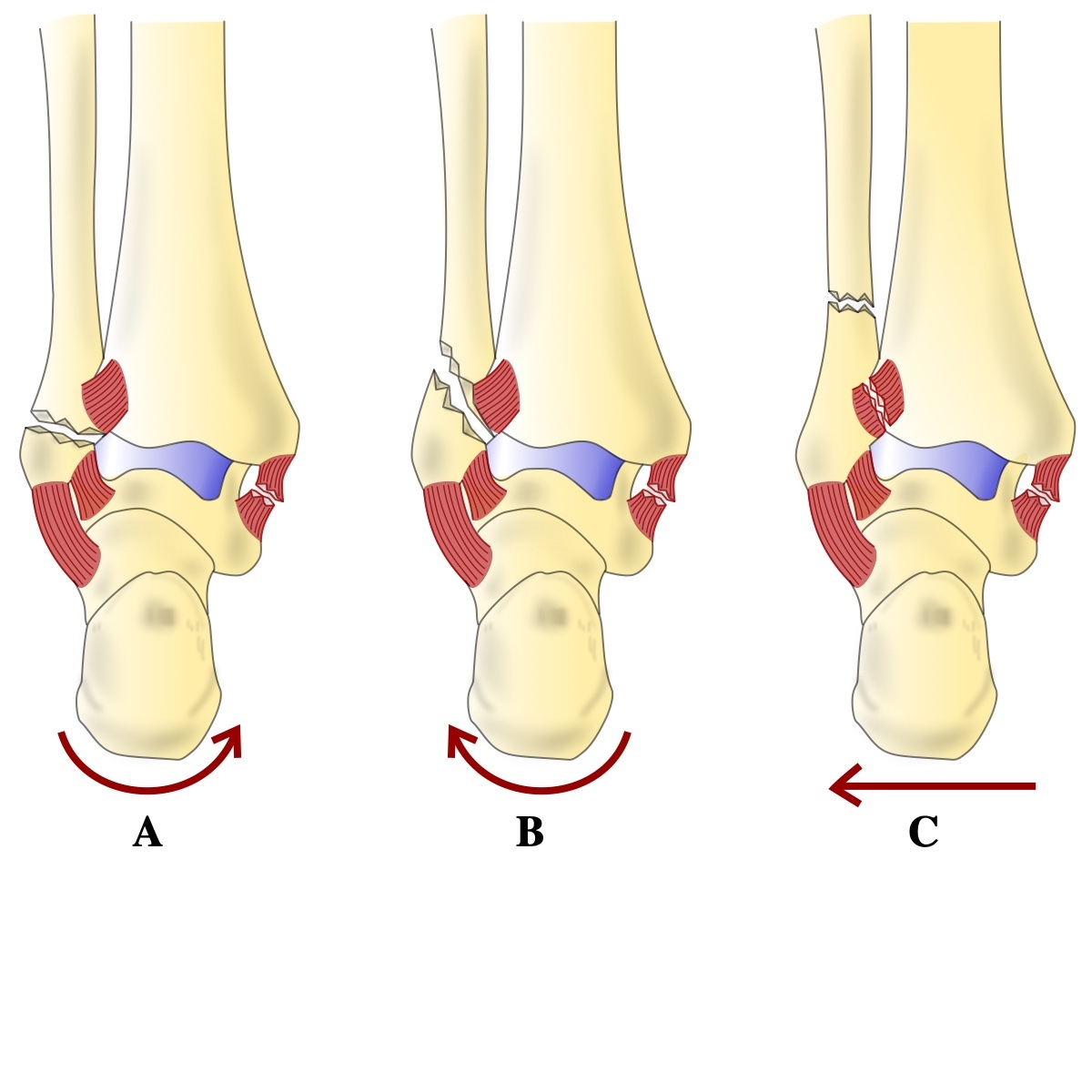 Figure 23. Danis-Weber classification of fibular fractures relative to the syndesmosis (type A below, B at, C above the syndesmosis, shown in blue). DrFO.Tn, CC BY 4.0, via Wikimedia Commons.
