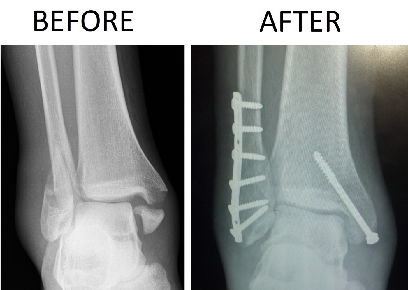 Figure 24. Ankle fracture before and after open reduction and internal fixation with a lateral fibular plate and a medial malleolar screw. Chaim Mintz, CC BY-SA 3.0, via Wikimedia Commons.