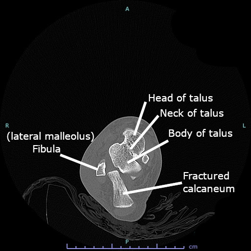 Figure 26. Axial CT of a calcaneal fracture through the hindfoot. Cerevisae, CC BY-SA 4.0, via Wikimedia Commons.