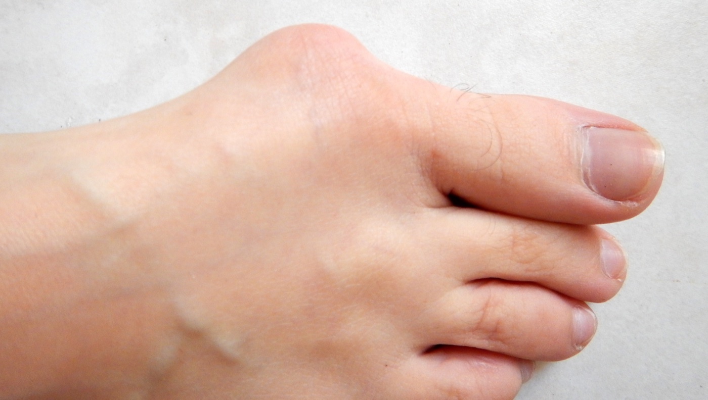 Figure 28. Clinical appearance of hallux valgus, with the prominent first metatarsophalangeal bunion and lateral deviation of the great toe. Lamiot, CC BY-SA 4.0, via Wikimedia Commons.