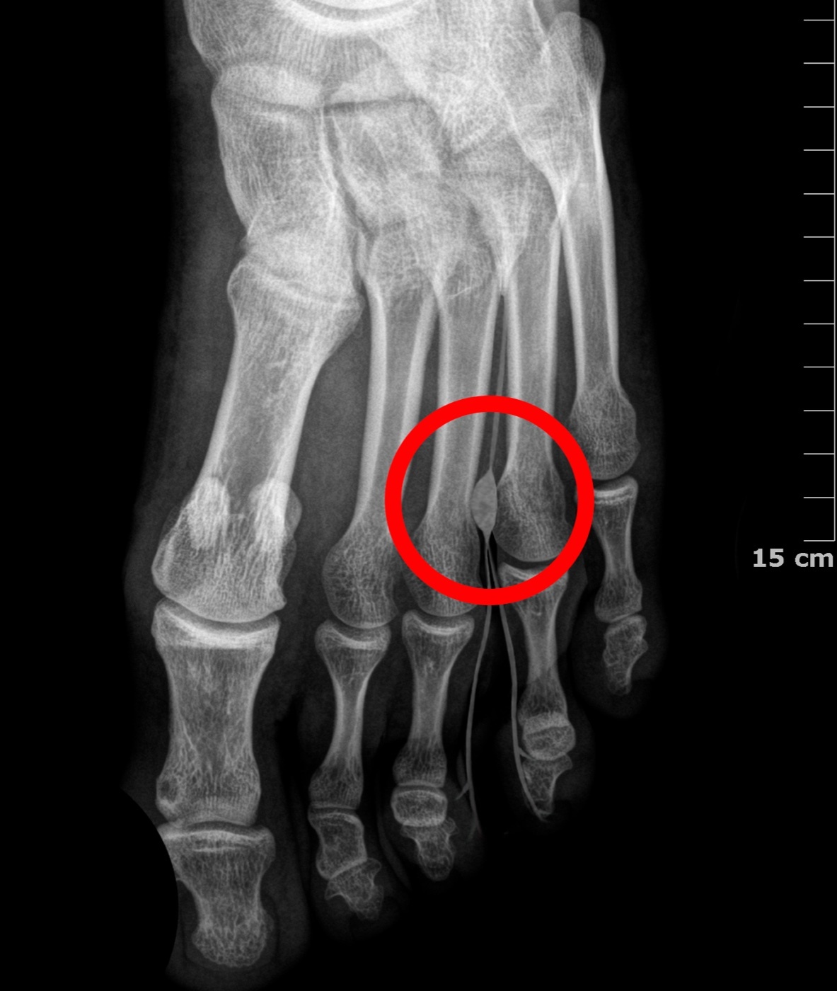 Figure 30. Forefoot radiograph indicating the third intermetatarsal web space, the typical site of a Morton neuroma. Nuñez Zapata Cascianini, CC BY-SA 4.0, via Wikimedia Commons.