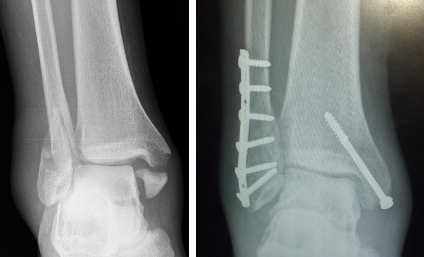 Figure 8. An ankle fracture before and after surgery: the displaced malleolar fracture (left) and ORIF with a lateral fibular plate and a medial malleolar screw (right). Radiographs by Chaim Mintz, CC BY-SA 4.0, via Wikimedia Commons.