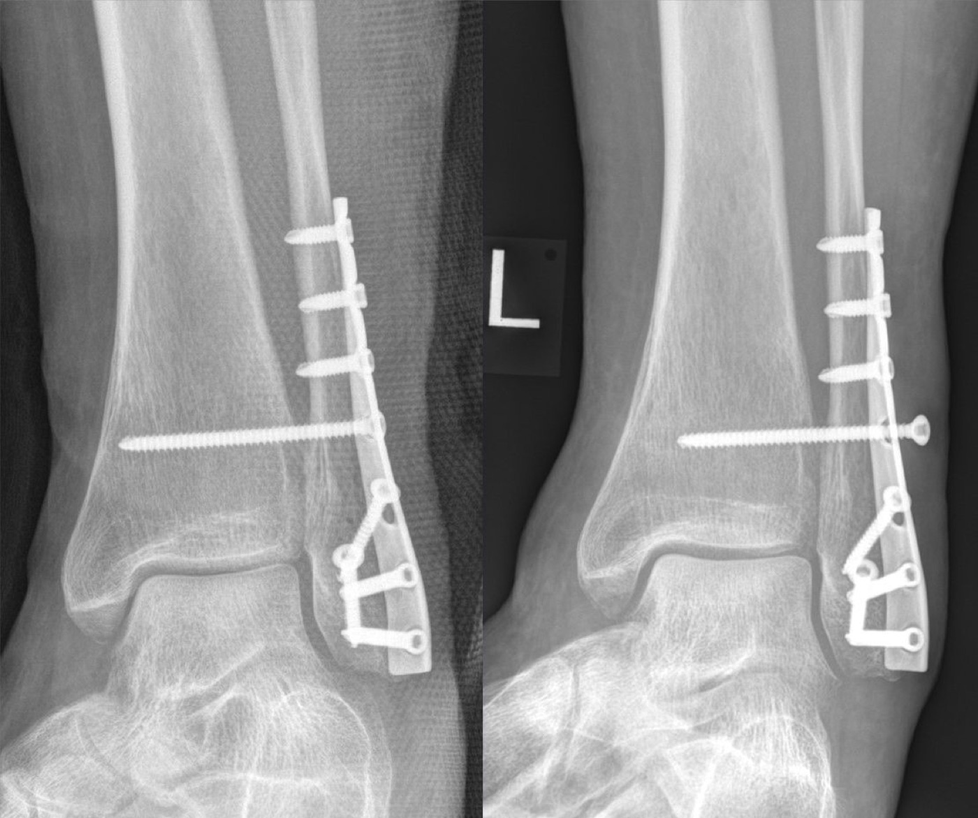 Figure 9. ORIF of a Weber C ankle fracture: fibular plating with a transsyndesmotic positioning (set) screw stabilising the distal tibiofibular joint above the plafond. Radiograph by Hellerhoff, CC BY-SA 4.0, via Wikimedia Commons.