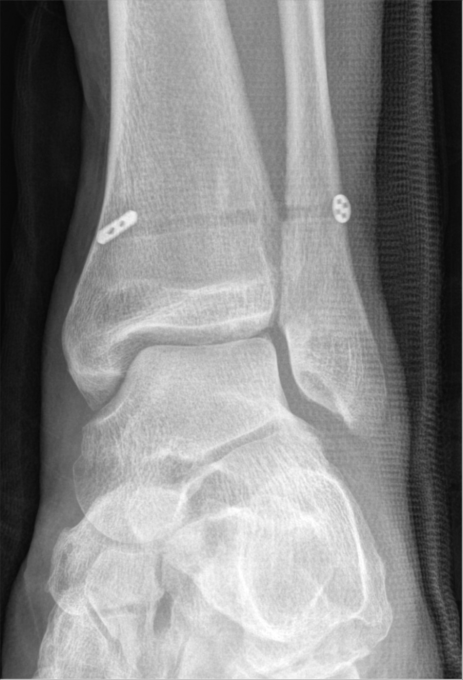 Figure 10. Suture-button (TightRope) fixation of a syndesmotic rupture, the dynamic alternative to a positioning screw, with paired cortical buttons on the medial tibia and lateral fibula. Radiograph by Hellerhoff, CC BY-SA 4.0, via Wikimedia Commons.