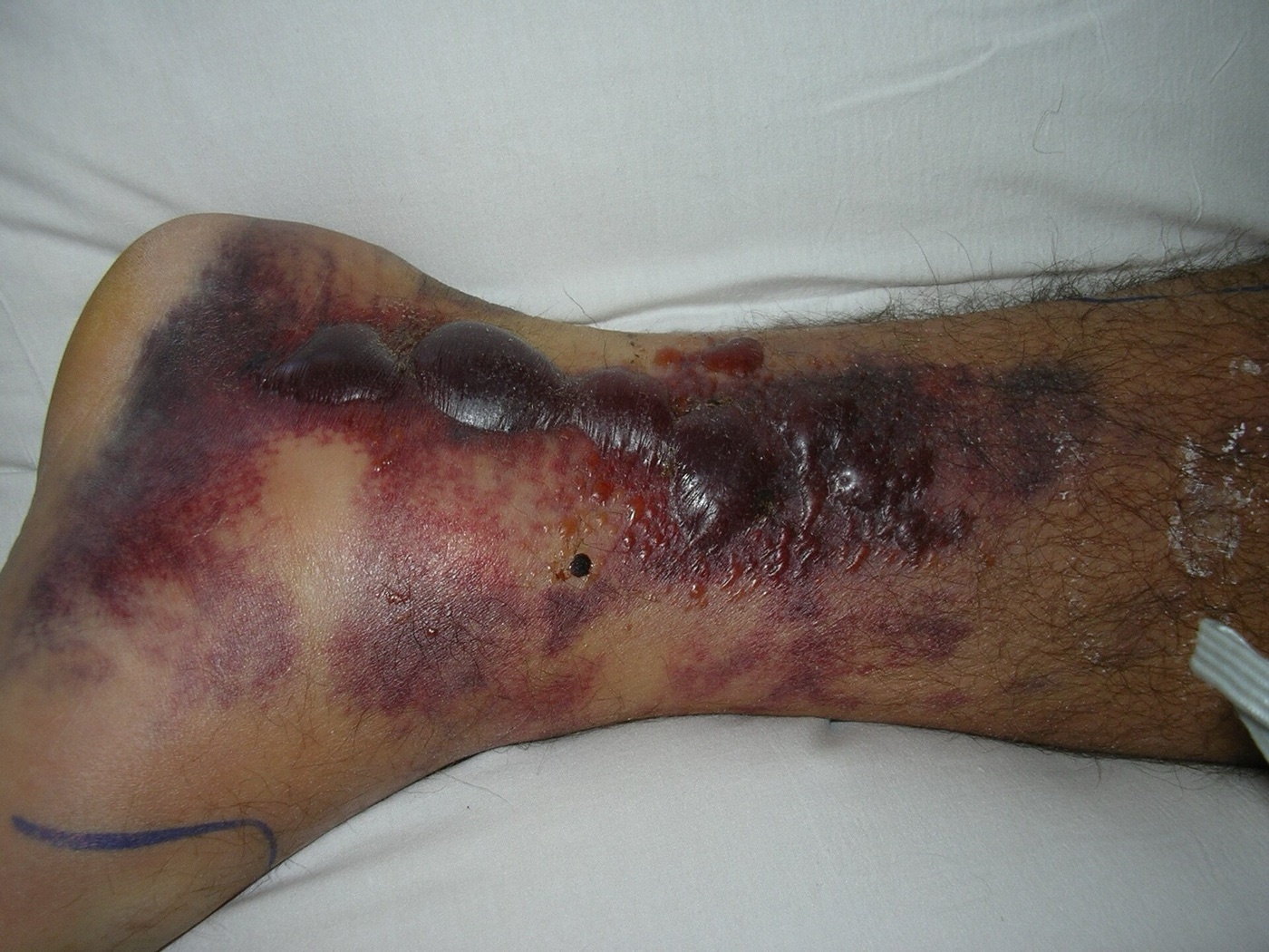 Figure 11. Fracture blisters and soft-tissue swelling over the distal leg: the kind of soft-tissue compromise that mandates staged management, with spanning external fixation before any definitive internal fixation. Photograph by Cindy L. Budge, public domain, via Wikimedia Commons.