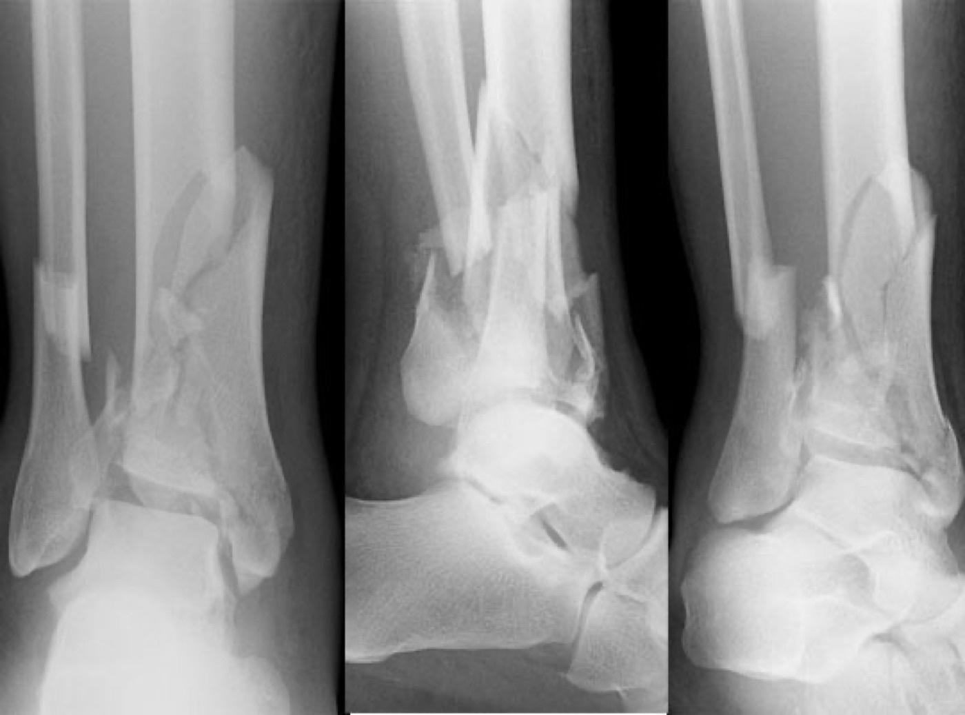 Figure 12. Tibial pilon (plafond) fracture: a comminuted, intra-articular fracture of the distal tibial weight-bearing surface produced by high-energy axial loading. Radiograph by Elhehir, CC BY-SA 4.0, via Wikimedia Commons.