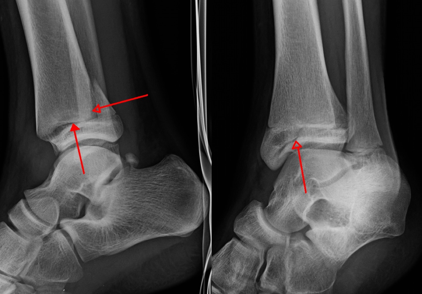 Figure 13. Paediatric triplane fracture of the distal tibia on plain radiographs (arrows); the open distal tibial physis is evident. Radiograph by James Heilman, MD, CC BY-SA 3.0, via Wikimedia Commons.