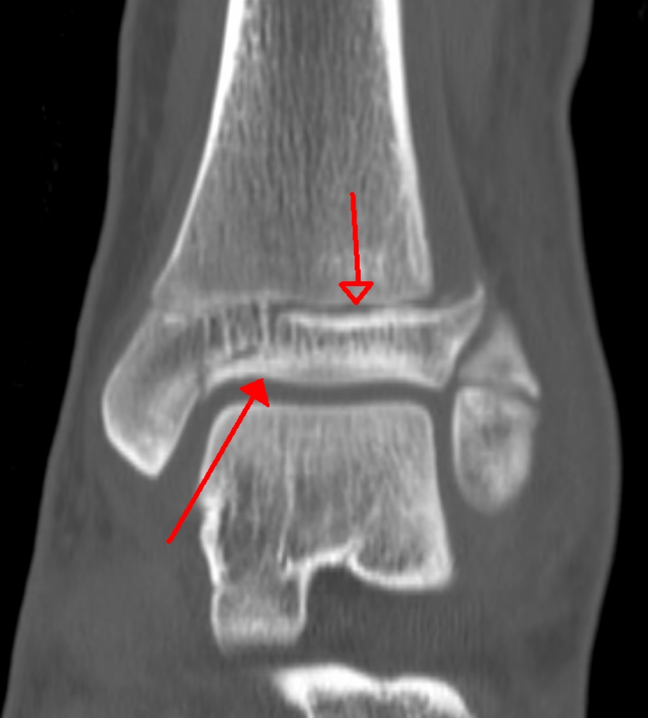 Figure 14. Triplane fracture on coronal CT, showing the multiplanar epiphyseal and metaphyseal components crossing the closing physis; CT defines the part-count and the articular step. Image by James Heilman, MD, CC BY-SA 3.0, via Wikimedia Commons.