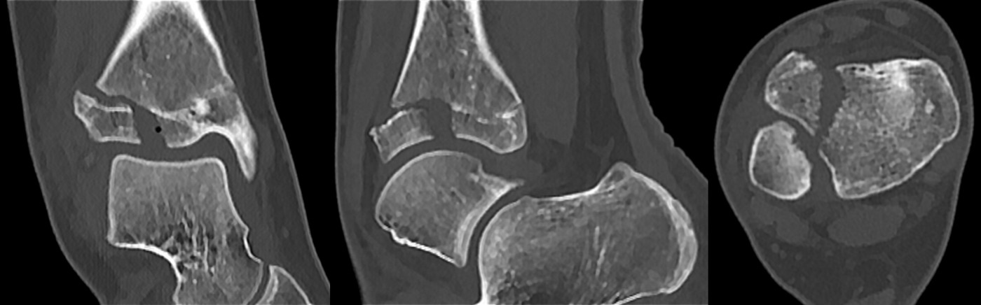 Figure 15. Juvenile Tillaux fracture on CT (sagittal, coronal and axial): the isolated anterolateral distal tibial epiphyseal fragment avulsed by the anterior inferior tibiofibular ligament. Image by Hellerhoff, CC BY-SA 3.0, via Wikimedia Commons.