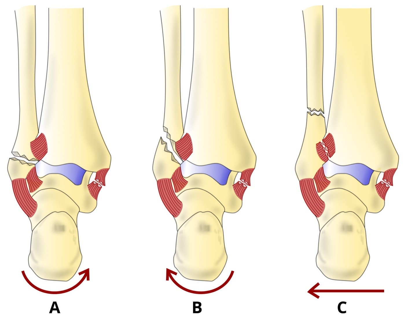 Figure 2. The Danis-Weber classification by the level of the fibular fracture relative to the syndesmosis: type A below (infrasyndesmotic), type B at (transsyndesmotic), and type C above (suprasyndesmotic) the joint line. Diagram by DrFO.Tn, CC BY 4.0, via Wikimedia Commons.