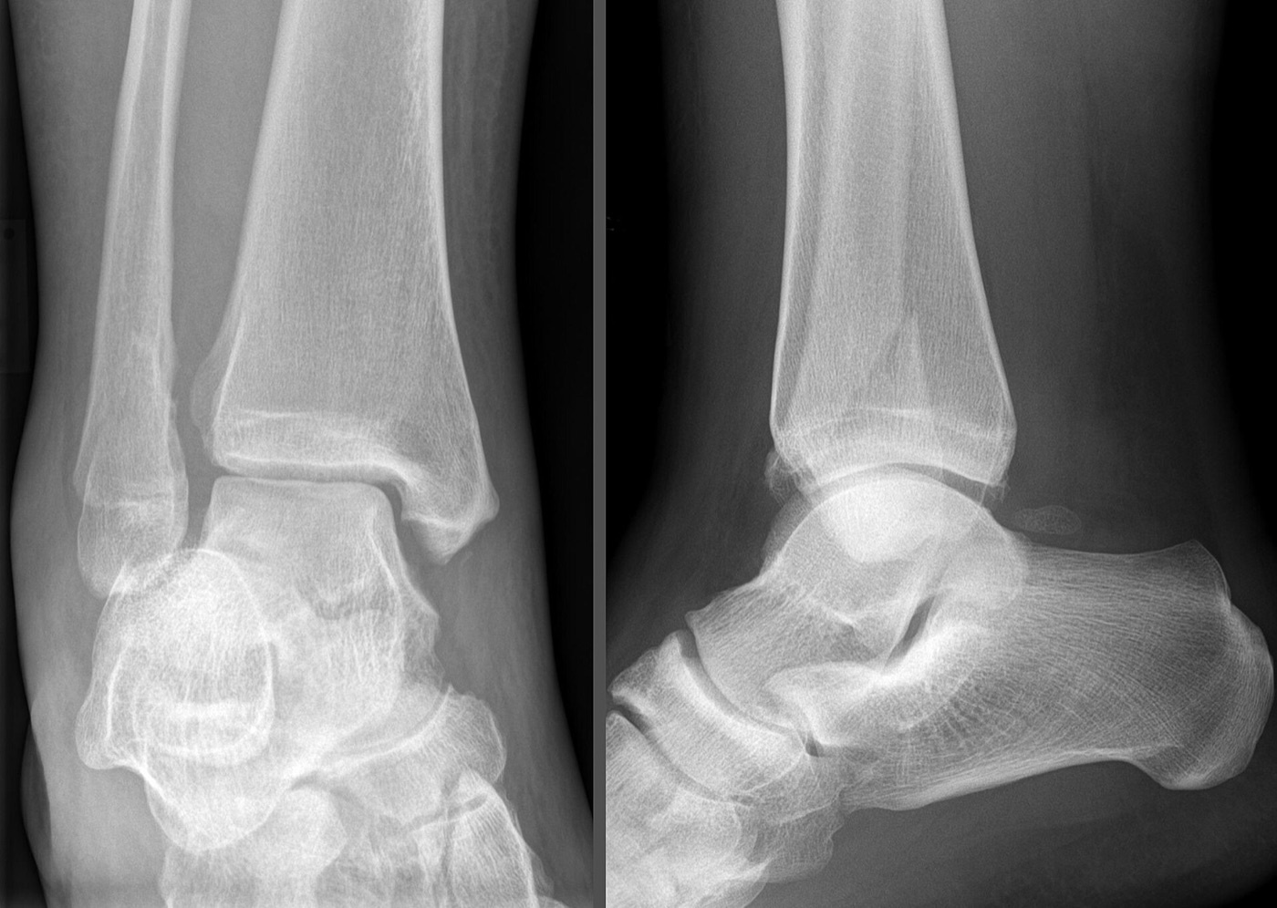 Figure 3. A Weber B fracture of the lateral malleolus: the oblique distal fibular fracture at the level of the syndesmosis, with its characteristic long posterior spike, on AP and lateral views. Radiograph by Hellerhoff, CC BY-SA 3.0, via Wikimedia Commons.