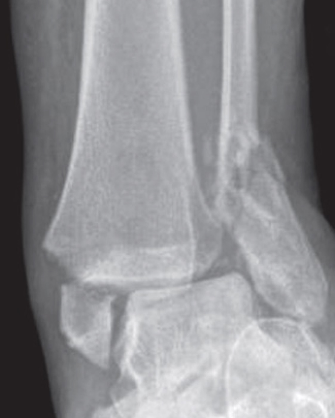 Figure 4. A bimalleolar ankle fracture: combined fractures of the lateral and medial malleoli on the AP view, an inherently unstable pattern. Radiograph by Tellisi, Abdulkareem and Giannoudis, CC BY 4.0, via Wikimedia Commons.