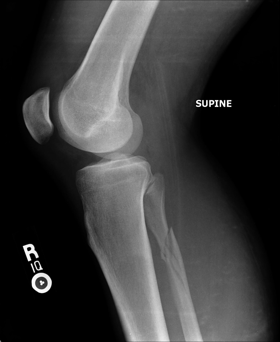 Figure 5. Maisonneuve fracture: the high fracture of the proximal fibula that accompanies a medial-side injury and a torn syndesmosis, often with a deceptively normal-looking ankle film. Radiograph by RotorMotor2, CC BY-SA 3.0, via Wikimedia Commons.
