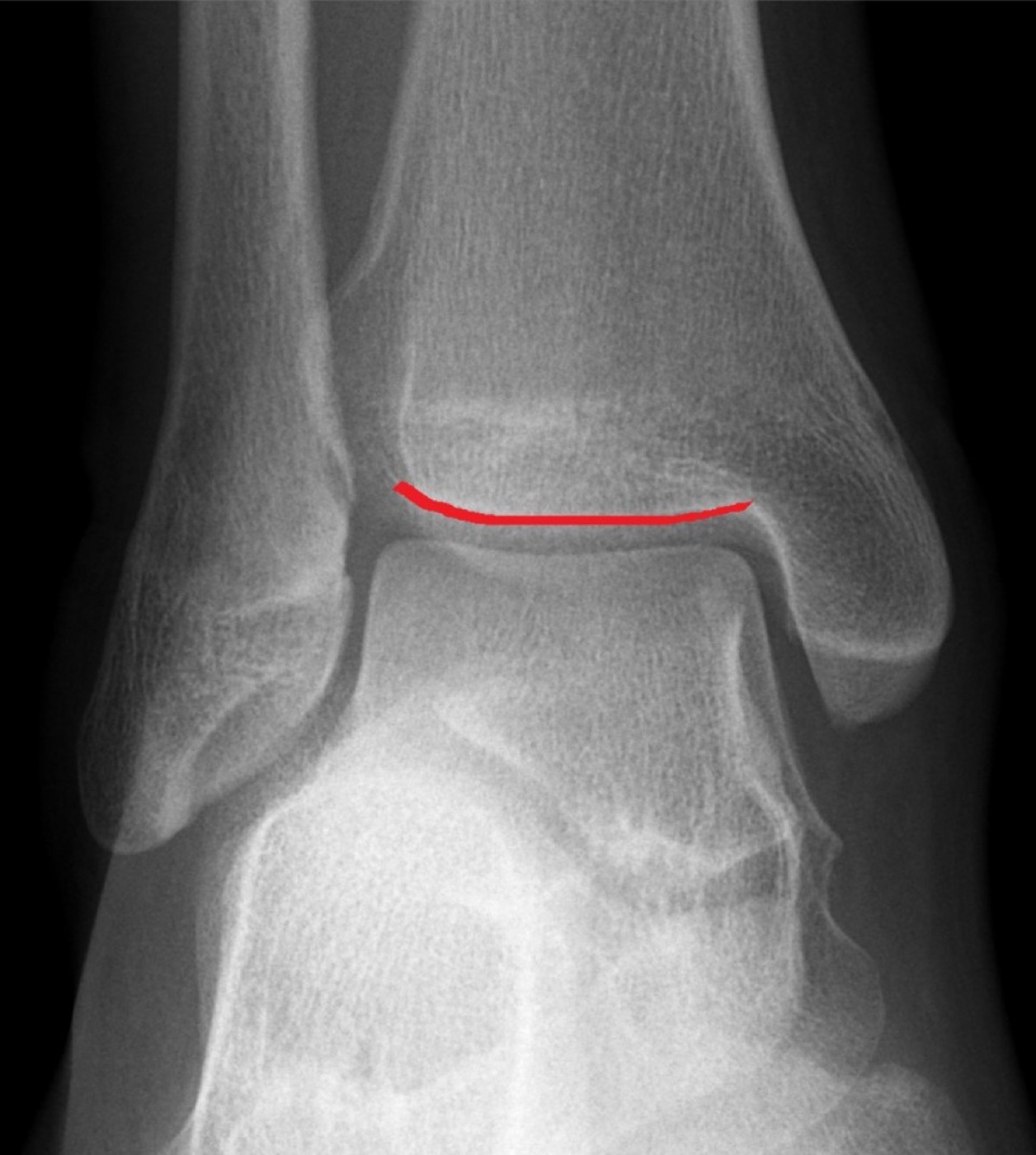 Figure 6. Mortise radiograph of the ankle with the tibial plafond marked: the reference view for the medial clear space, the tibiofibular clear space and overlap, and the congruent position of the talus beneath the plafond. Radiograph by Hellerhoff, CC BY-SA 4.0, via Wikimedia Commons.