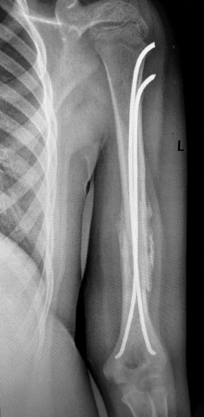 Figure 17. Intramedullary fixation of a displaced humeral shaft fracture with elastic nails. Ivtorov, CC BY-SA 4.0, via Wikimedia Commons.