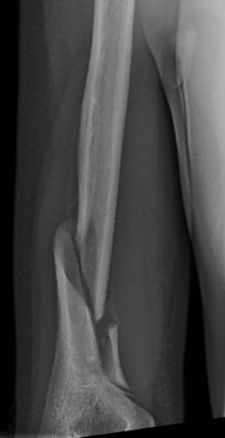 Figure 14. Holstein-Lewis fracture: a spiral fracture of the distal third of the humeral shaft, the pattern classically associated with radial nerve palsy. Public domain, via Wikimedia Commons.