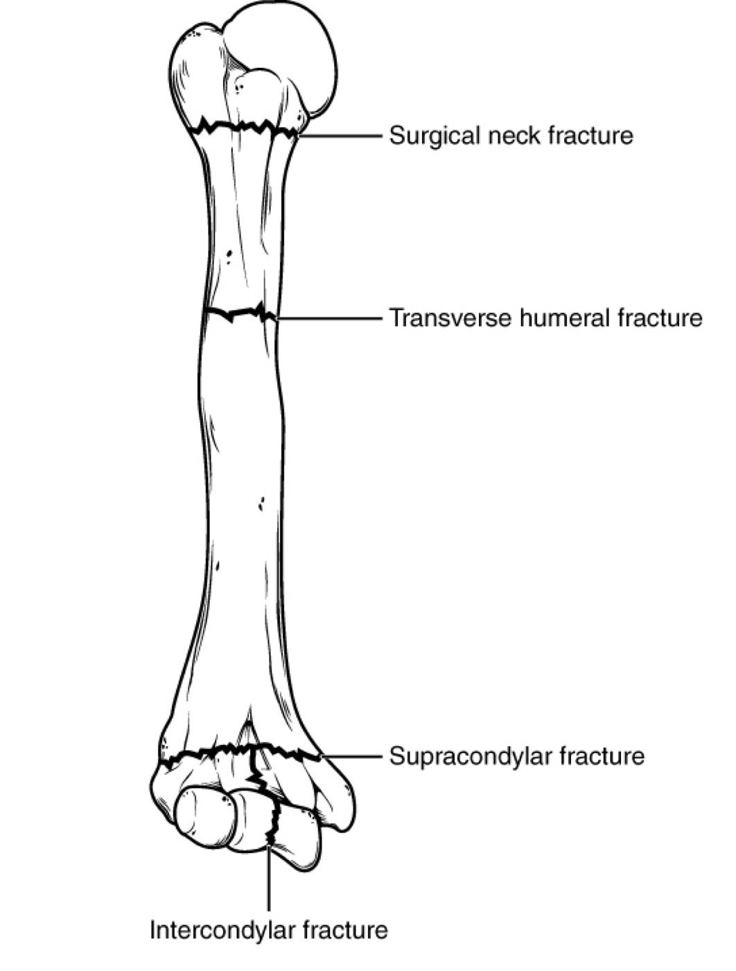 Figure 15. Common humeral fracture locations: surgical neck, transverse shaft, supracondylar and intercondylar. OpenStax College, CC BY 3.0, via Wikimedia Commons.
