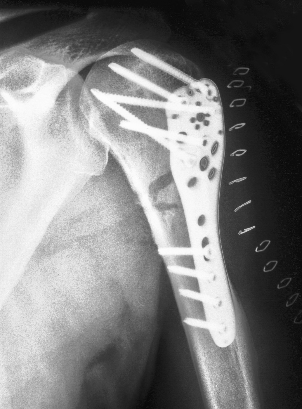 Figure 16. Open reduction and internal fixation of a proximal humeral fracture with an angular-stable locking plate, one of the constructs applied through the anterior approach. Thomas Zimmermann (THWZ), CC BY-SA 3.0 DE, via Wikimedia Commons.