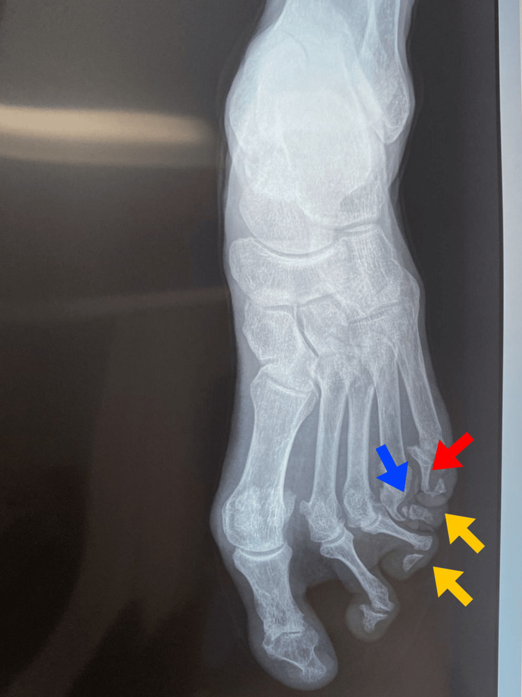 Pencil-in-cup deformity in psoriatic arthritis mutilans (foot radiograph): osteolysis whittles the proximal phalanx into the cupped base of its neighbour. Altamirano De La Cruz et al., Cureus 2025, CC BY 4.0.