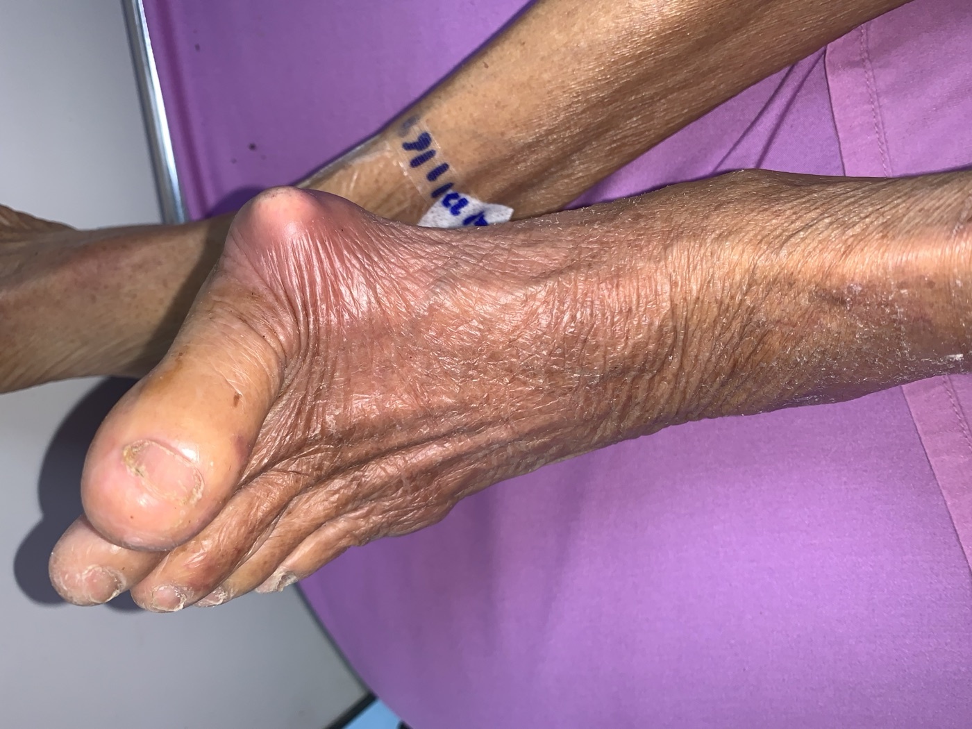 Tophaceous gout at the first MTP joint (podagra). A large erythematous tophus over the great-toe joint. Image: Chainwit., CC BY 4.0, via Wikimedia Commons.
