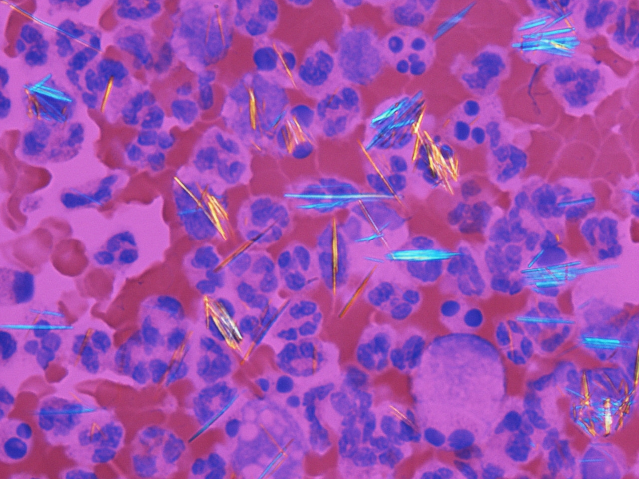 Monosodium urate crystals. Needle-shaped, strongly negatively birefringent crystals under compensated polarised light - the definitive diagnosis of gout. Image: Gabriel Caponetti, CC BY-SA 3.0, via Wikimedia Commons.