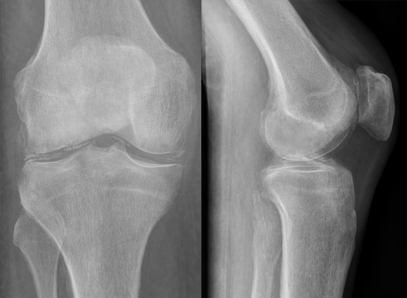 Chondrocalcinosis of the knee (CPPD). AP and lateral radiographs showing linear calcification of the menisci and articular cartilage. Image: Hellerhoff, CC BY-SA 4.0, via Wikimedia Commons.