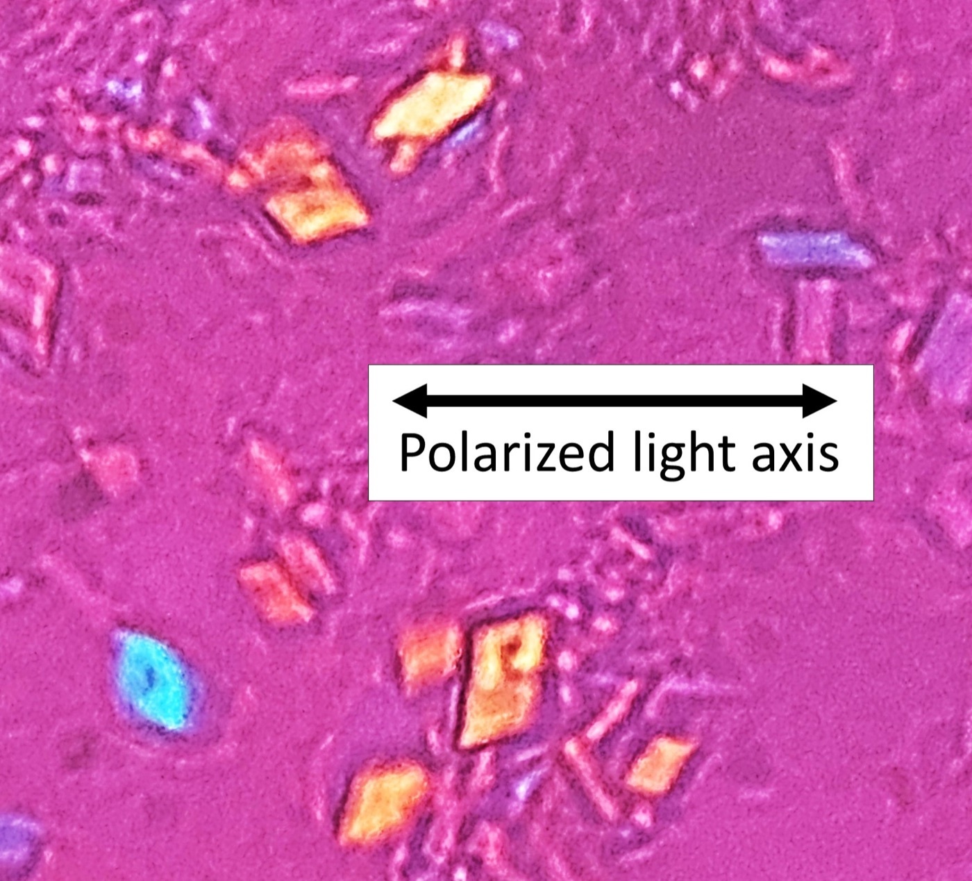 Calcium pyrophosphate crystals. Rhomboid, weakly positively birefringent crystals under compensated polarised light. Image: Mikael Häggström, CC0, via Wikimedia Commons.