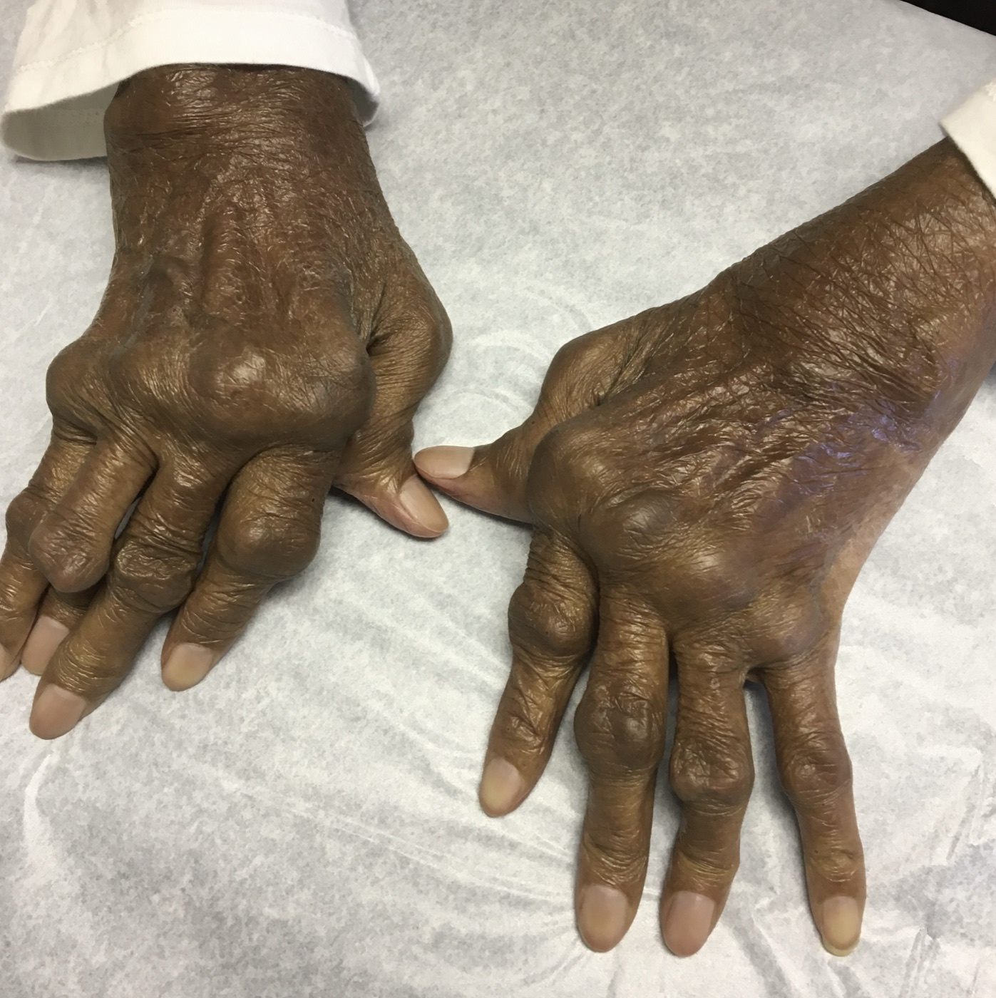 Rheumatoid hand deformities. Dorsal view of both hands: MCP swelling, ulnar deviation of the digits and multiple finger deformities of long-standing rheumatoid arthritis. Image: D. Gannavarapu Narasimha Murthy, CC0, via Wikimedia Commons.