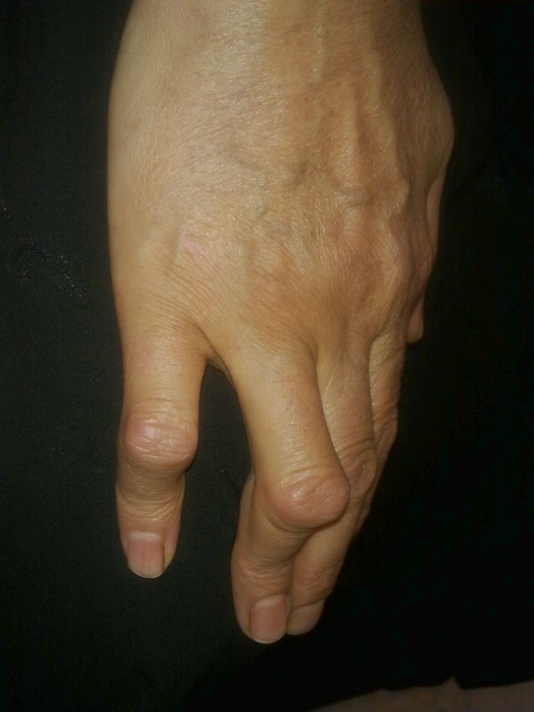 Boutonnière deformity (PIP flexion with DIP hyperextension). Image: Alborz Fallah, CC BY-SA 3.0, via Wikimedia Commons.