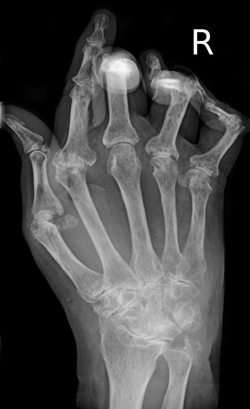 Advanced rheumatoid arthritis of the hand (AP radiograph). Gross metacarpophalangeal destruction, marginal erosions, joint-space loss and periarticular osteopenia. Image: Bernd Brägelmann, CC BY 3.0, via Wikimedia Commons.