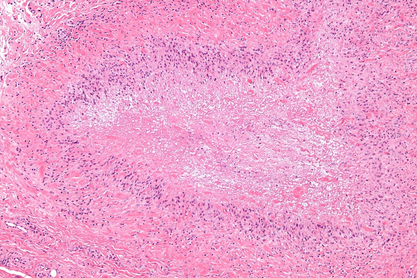 Rheumatoid nodule (histology). Central fibrinoid necrosis surrounded by palisading histiocytes - the characteristic palisading granuloma. Image: Nephron, CC BY-SA 3.0, via Wikimedia Commons.
