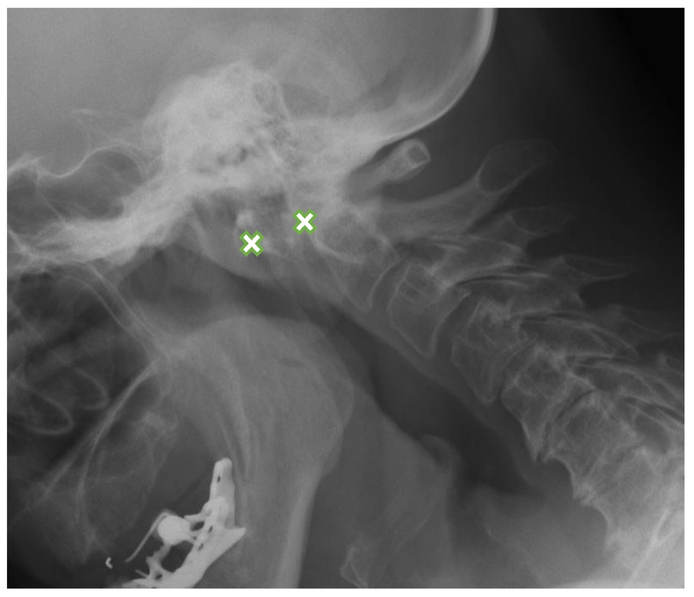 Atlantoaxial subluxation in rheumatoid arthritis. Flexion lateral cervical radiograph; the anterior atlanto-dental interval (between the crosses) measures 8.8 mm, indicating C1-C2 instability. Kotecki et al., J Clin Med 2021, CC BY 4.0.