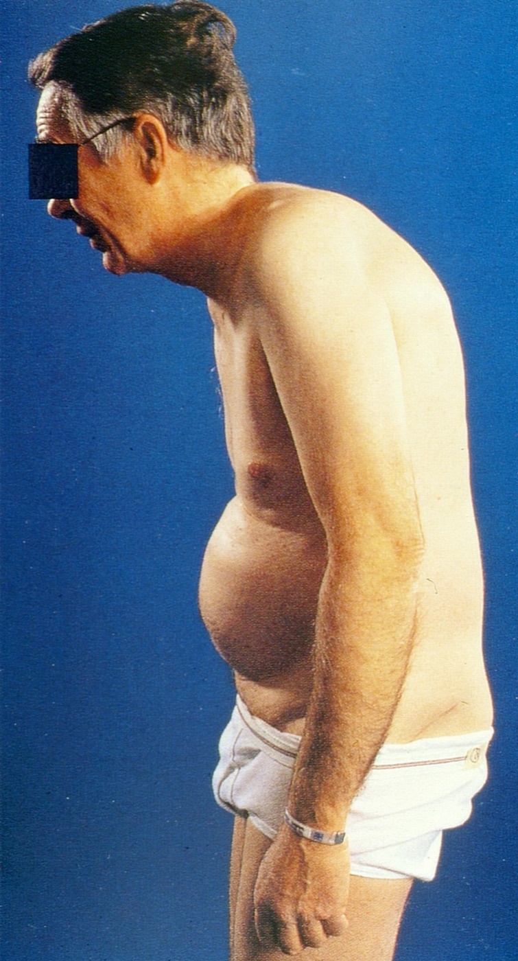 Fixed kyphotic posture of advanced ankylosing spondylitis - the stooped “question-mark” stance with a protuberant abdomen. Image: Mehlauge, CC BY-SA 3.0, via Wikimedia Commons.
