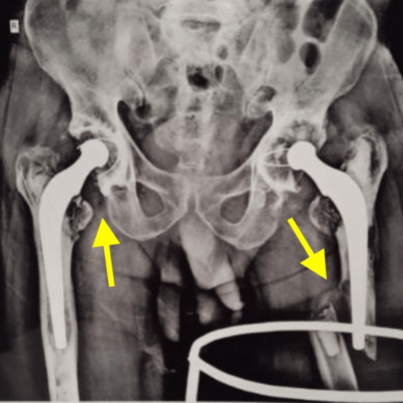 Figure 12. Periprosthetic femoral fracture (Vancouver B3) around the left stem of a bilateral total hip arthroplasty (arrows). From Suneja et al. (2024), Cureus 16(2):e53895, PMC10925070, Fig. 1, CC BY 4.0.