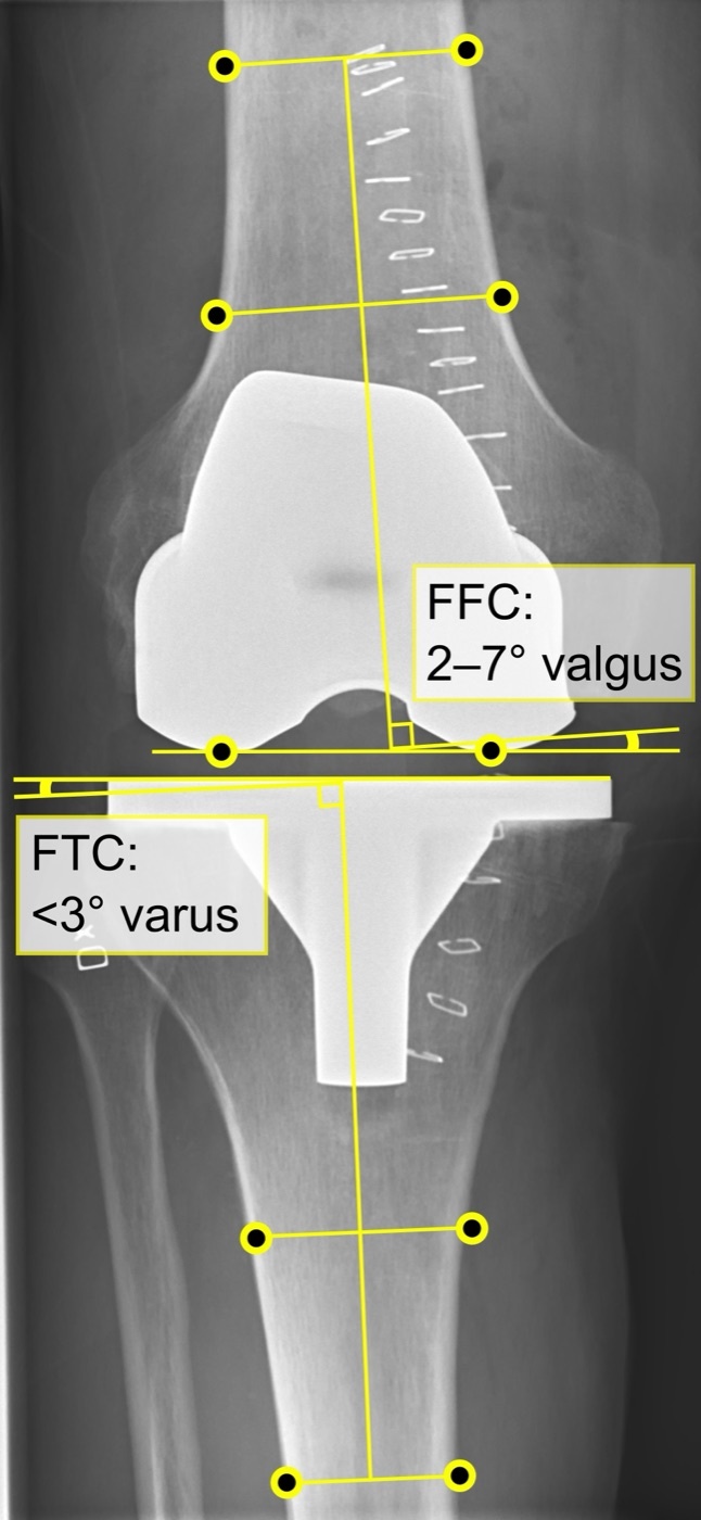 Figure 14. AP radiograph of a total knee replacement with post-operative alignment angles annotated. Source: Mikael Häggström, M.D., via Wikimedia Commons, CC0 1.0.