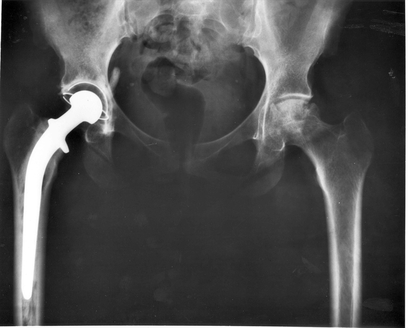Figure 3. AP pelvic radiograph of a total hip replacement in situ (acetabular cup, head and femoral stem). Source: NIH / NIADDK, via Wikimedia Commons, public domain.