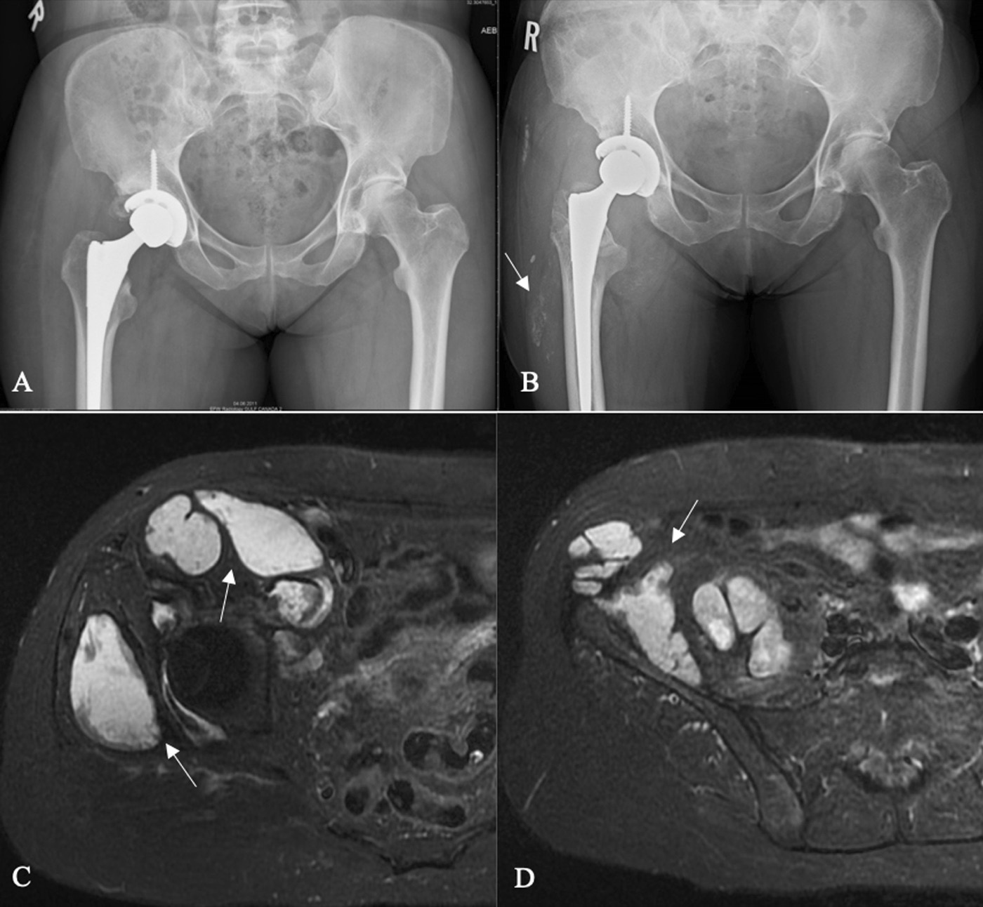 Figure 5. Adverse local tissue reaction to metal debris: AP radiographs (A, B) and axial MRI (C, D) showing a cystic pseudotumour mass around a hip arthroplasty. From Mastel et al. (2022), J Med Case Reports 16:115, PMC8941771, Fig. 1, CC BY 4.0.