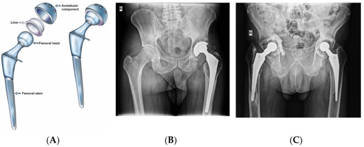 Figure 6. Total hip arthroplasty: (A) labelled components; (B) polyethylene wear/particle disease 15 years after a cementless metal-on-polyethylene THA; (C) aseptic loosening of a cemented THA. From Savin et al. (2023), Polymers 15:3278, PMC10422432, Fig. 1, CC BY 4.0.