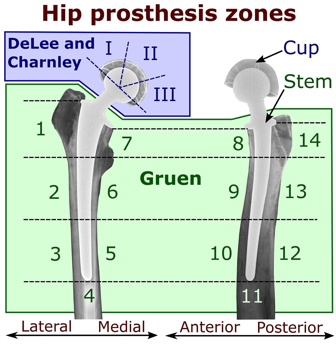Figure 10. Periprosthetic zone systems: the Gruen zones (femoral component) and the DeLee-Charnley zones (acetabular component) used to describe radiolucencies, osteolysis and stress shielding. Source: Mikael Häggström, via Wikimedia Commons, CC0 1.0.