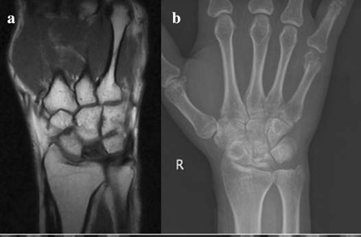 Kienböck disease: (a) coronal wrist MRI with diffuse low signal throughout the lunate; (b) the matching PA radiograph. (Xie et al., via Wikimedia Commons; CC BY-SA 4.0.)