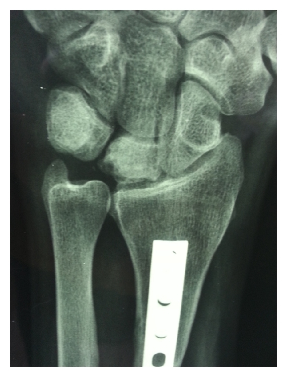 Postero-anterior wrist after a radial shortening osteotomy (distal-radius plate) for Lichtman IIIA Kienböck disease. (Dehghani et al., via Wikimedia Commons; CC BY 4.0.)
