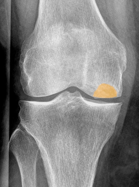 Antero-posterior knee in spontaneous osteonecrosis (Ahlbäck disease) of a 78-year-old woman: the subchondral lucent/flattened lesion of the medial femoral condyle is highlighted (orange overlay on a real radiograph). (Hellerhoff, Wikimedia Commons; CC BY-SA 4.0.)