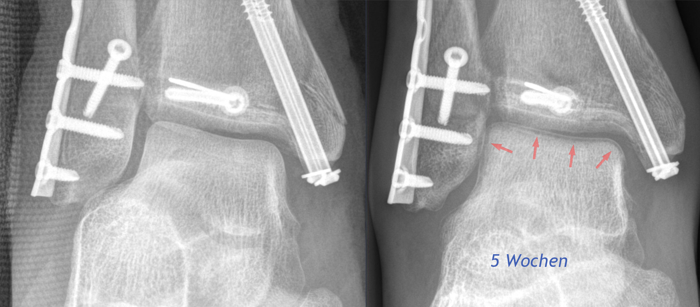 Hawkins sign: AP ankle radiographs after fixation, with arrows (right panel, “5 weeks”) marking the subchondral lucent band in the talar dome - evidence of preserved talar vascularity and a good prognostic sign. (Hellerhoff, Wikimedia Commons; CC BY-SA 4.0.)