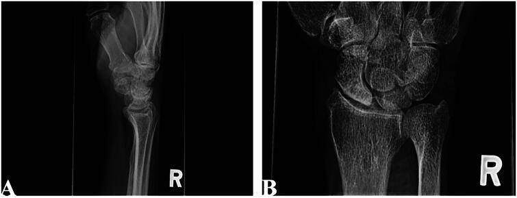 Preiser disease (idiopathic scaphoid osteonecrosis): lateral (A) and PA (B) wrist radiographs showing a dense, sclerotic proximal pole of the scaphoid. (Topham, Wehrli & Kadar, Case Rep Plast Surg Hand Surg 2024; CC BY-NC - non-commercial.)