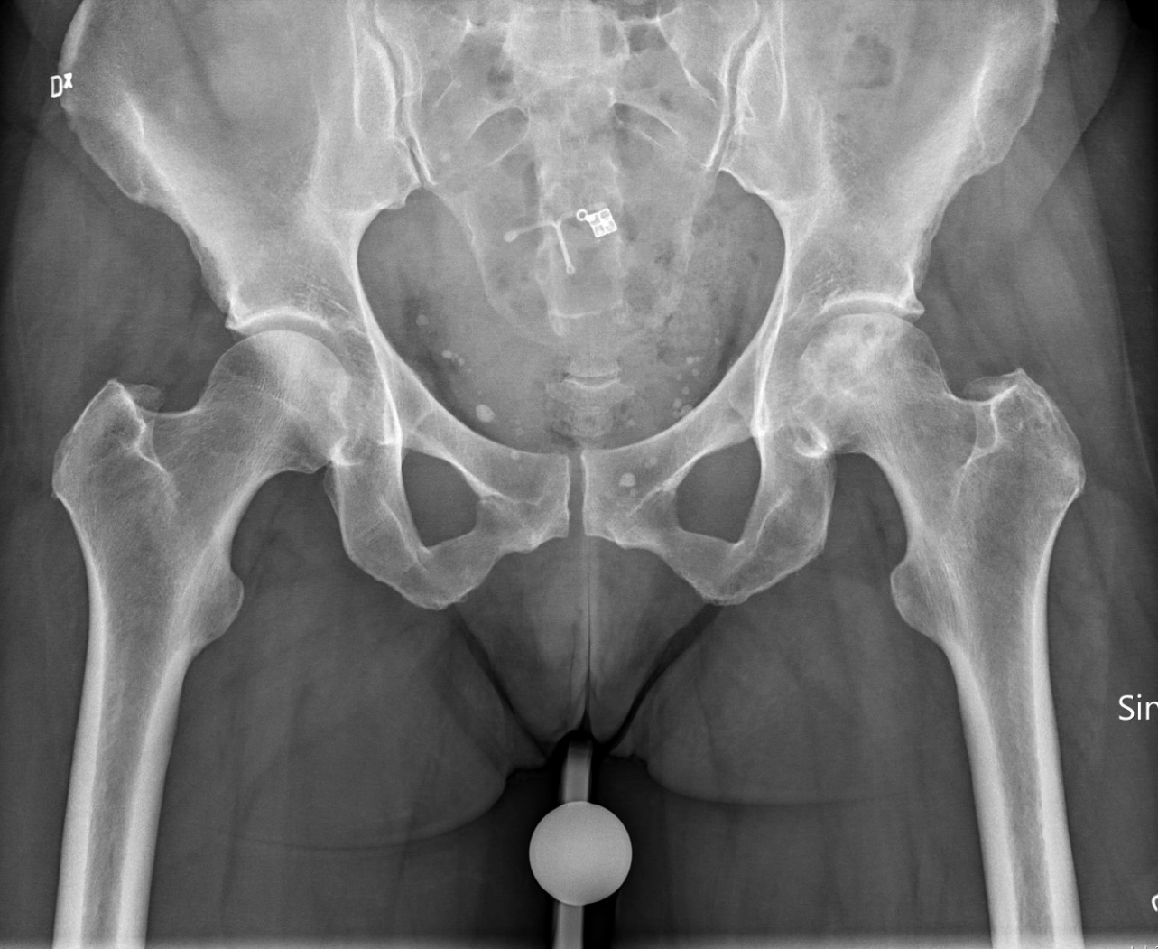 Antero-posterior pelvis showing bilateral idiopathic osteonecrosis of the femoral heads: both heads have mottled subchondral sclerosis and lucency. (Mikael Häggström MD, Wikimedia Commons; CC0.)