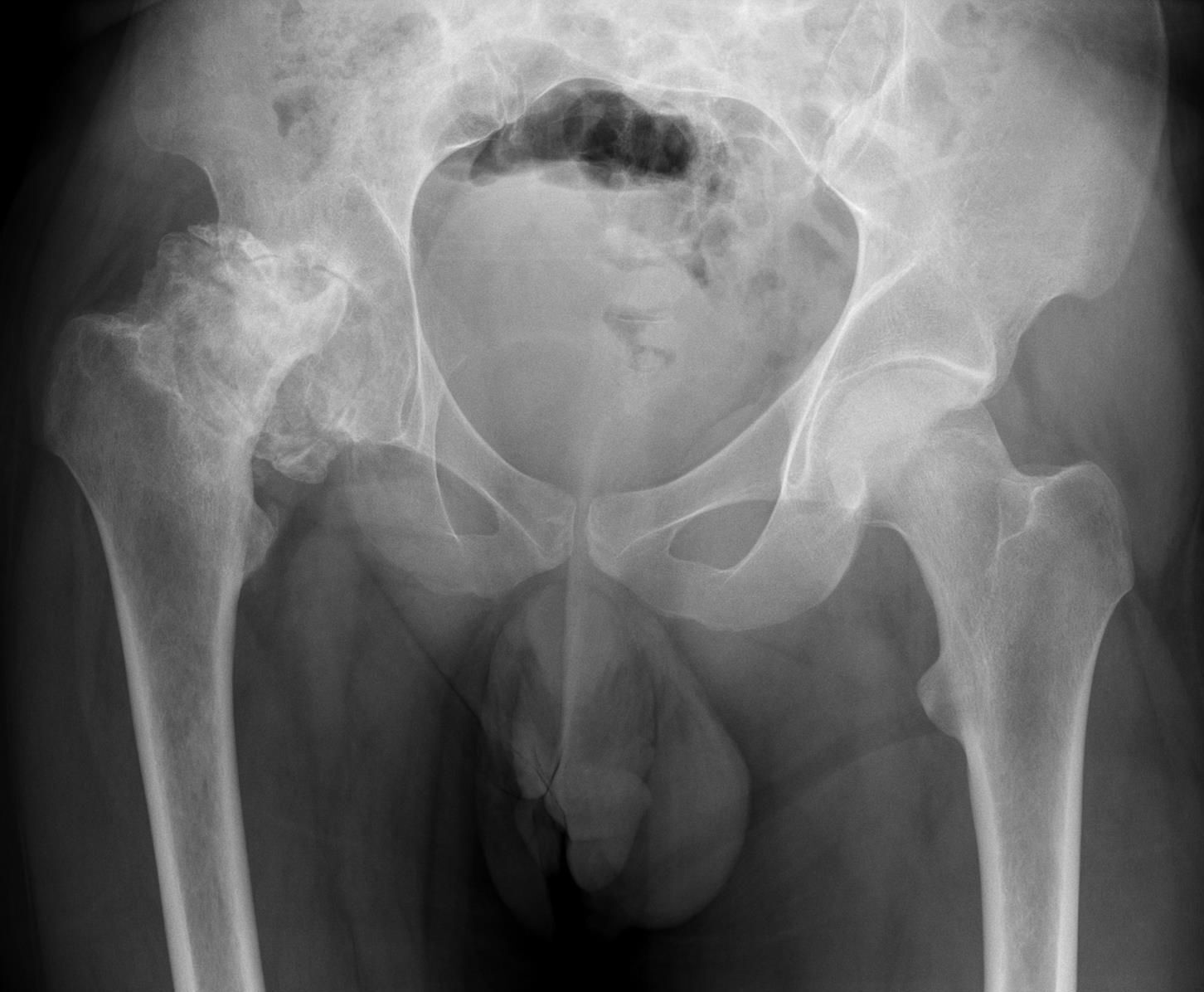 Antero-posterior pelvis in advanced steroid-induced osteonecrosis: the right femoral head (image left) shows collapse, fragmentation and sclerosis. (Hellerhoff, Wikimedia Commons; CC BY-SA 3.0.)