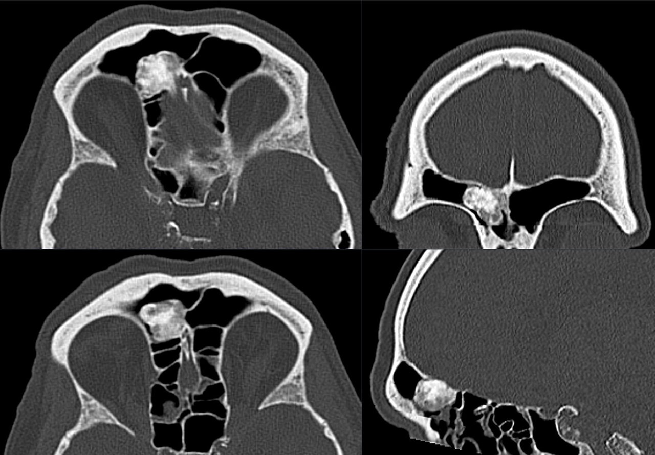 Figure 1. Osteoma - dense, well-circumscribed “ivory” lesion of the right frontal/ethmoid sinus (bone-window CT). Hellerhoff, CC BY-SA 4.0, Wikimedia Commons.