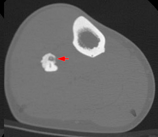 Figure 2. Osteoid osteoma - small lucent nidus with central mineralisation and surrounding reactive sclerosis (fibula, CT). Hellerhoff, CC BY-SA 3.0, Wikimedia Commons.