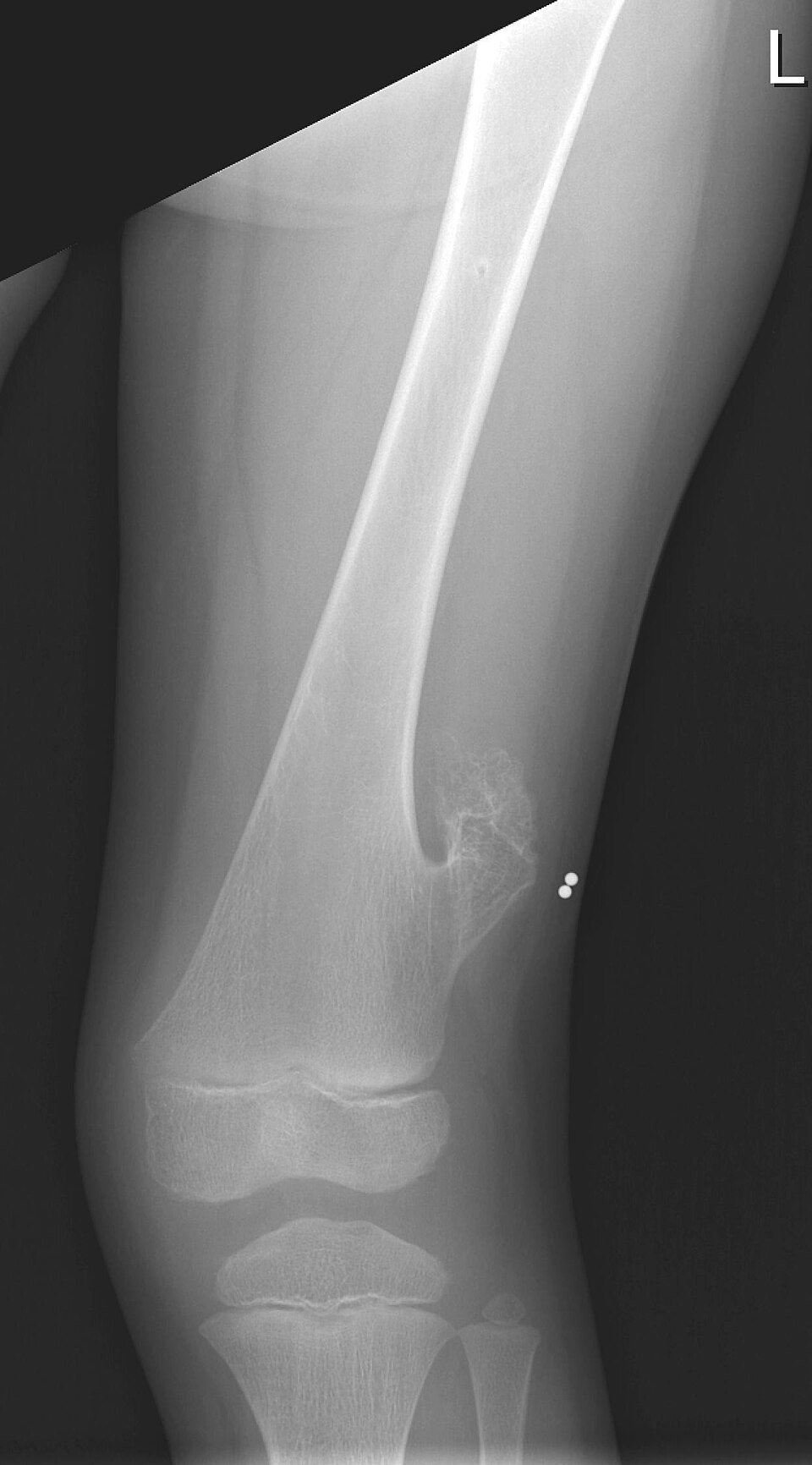 Figure 5. Osteochondroma - distal-femoral metaphyseal exostosis with cortical and medullary continuity, pointing away from the joint. Lucien Monfils, CC BY-SA 3.0, Wikimedia Commons.